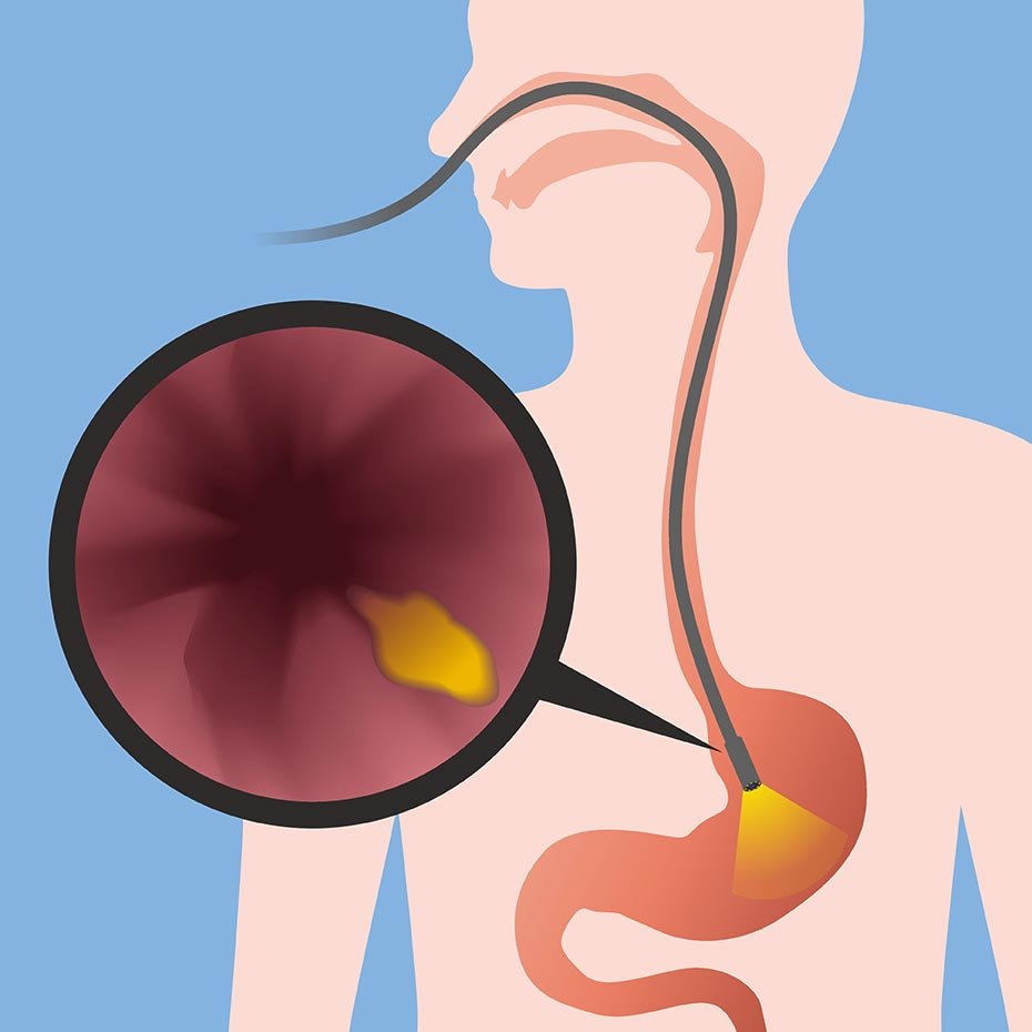 Illustration of an endoscopy procedure, showing a scope inserted into the digestive tract with a zoomed-in view of a lesion in the stomach lining.