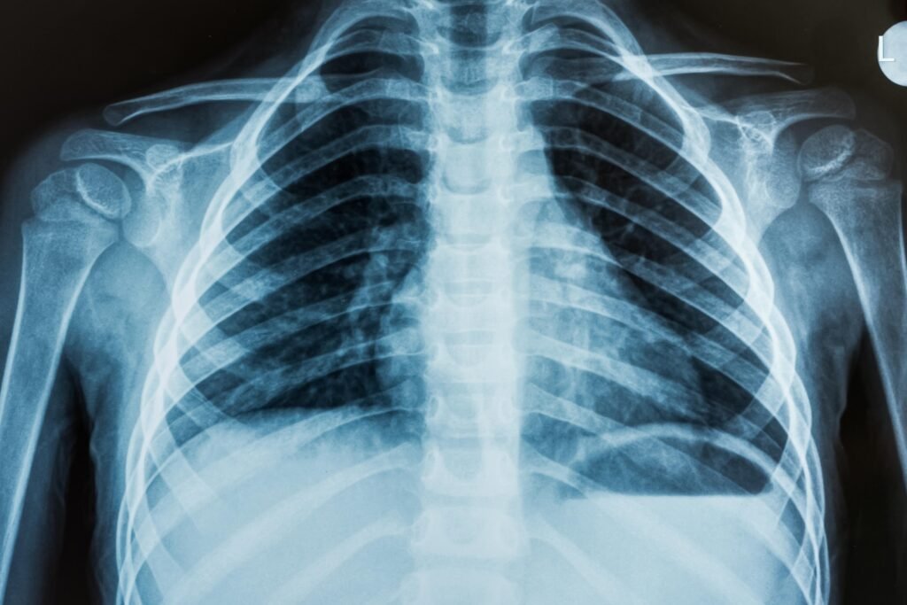 Chest X-ray showing the skeletal structure and lung field.
