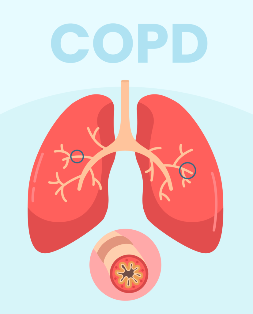 Infographic illustrating the causes, symptoms, and management strategies for Chronic Obstructive Pulmonary Disease (COPD).