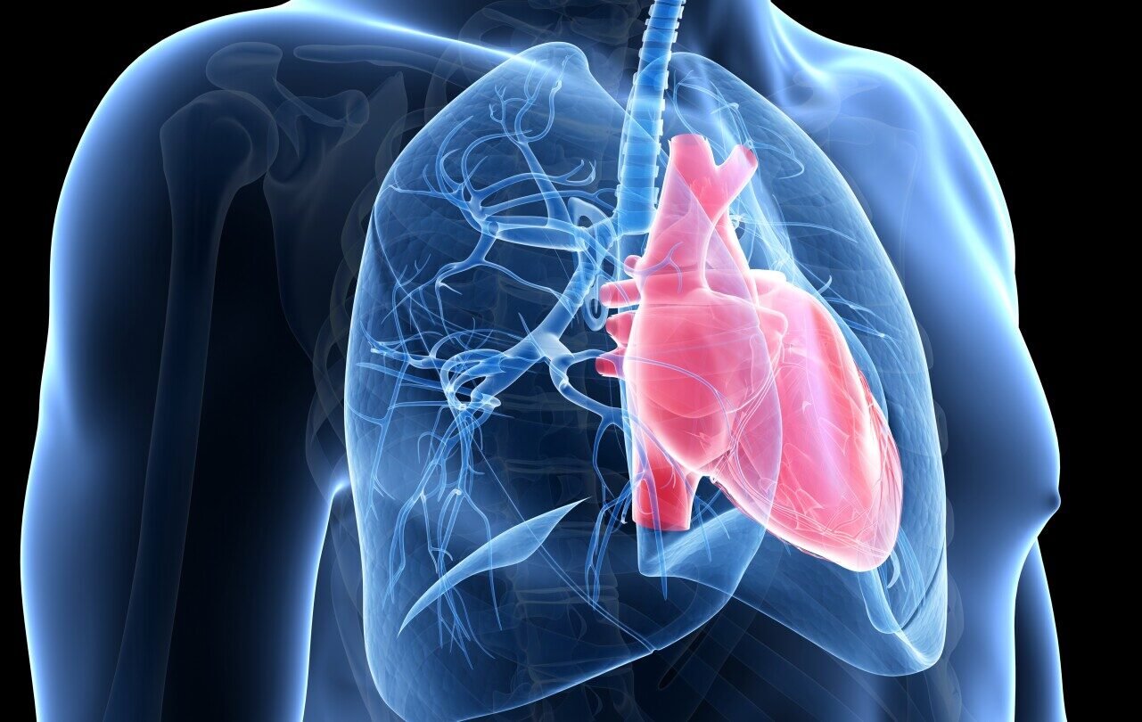 Chest X-ray showing enlarged pulmonary arteries and right ventricular hypertrophy indicative of pulmonary hypertension.