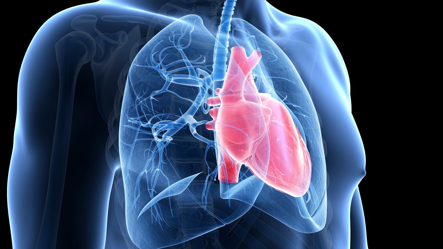 Chest X-ray showing enlarged pulmonary arteries and right ventricular hypertrophy indicative of pulmonary hypertension.