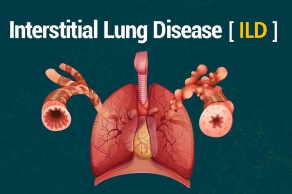 Chest X-ray displaying reticular opacities indicative of Interstitial Lung Disease
