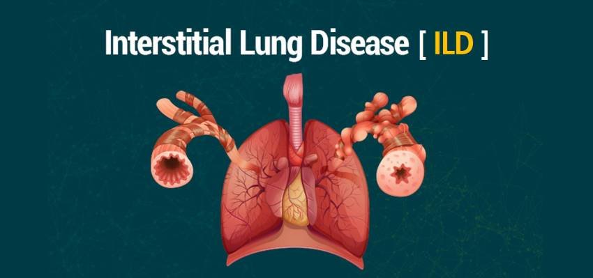 Chest X-ray displaying reticular opacities indicative of Interstitial Lung Disease