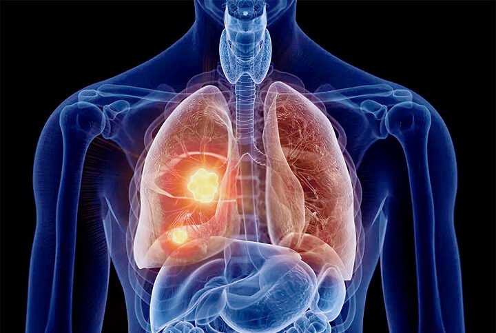 Chest X-ray revealing a mass in the right lung indicative of lung cancer.