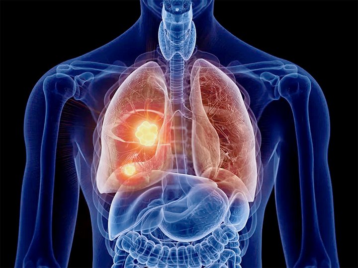 Chest X-ray revealing a mass in the right lung indicative of lung cancer.
